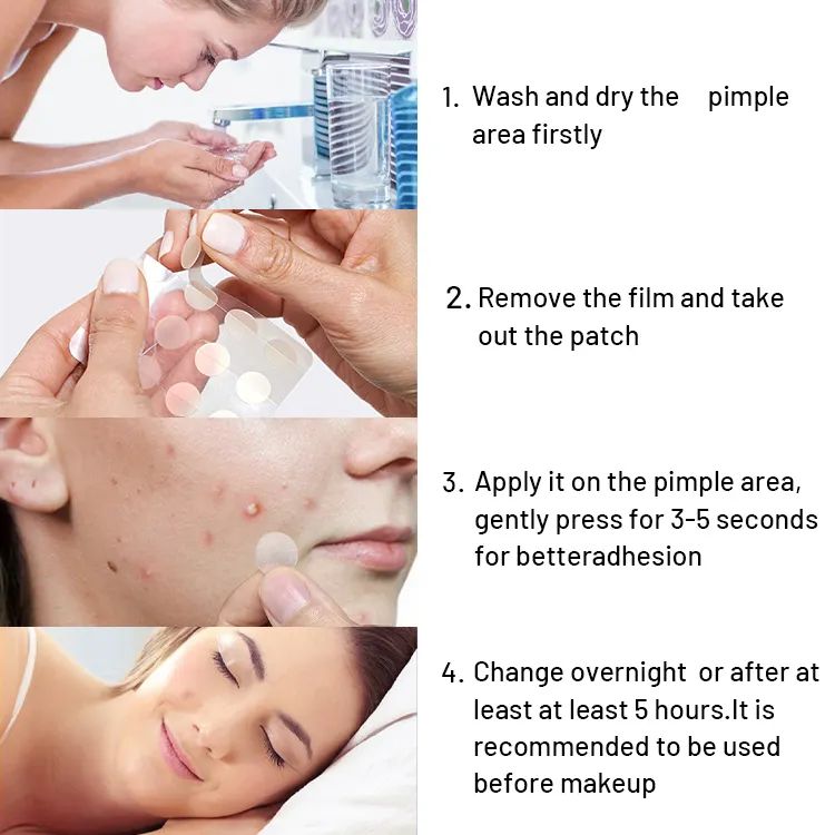 Hydrocolloid Acne Pimple Patch – Floderma